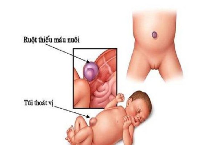 Thoát vị rốn - Hình ảnh minh họa